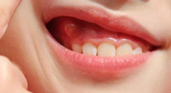 Swollen Gums in Kids: When to Worry and What to Do