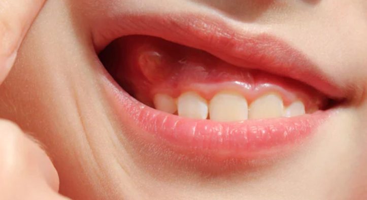 Swollen Gums in Kids: When to Worry and What to Do