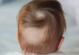 Alopecia Areata in Kids