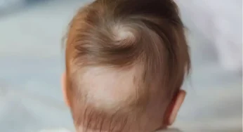 When Hair Vanishes Overnight: The Scary Reality of Alopecia Areata in Kids!