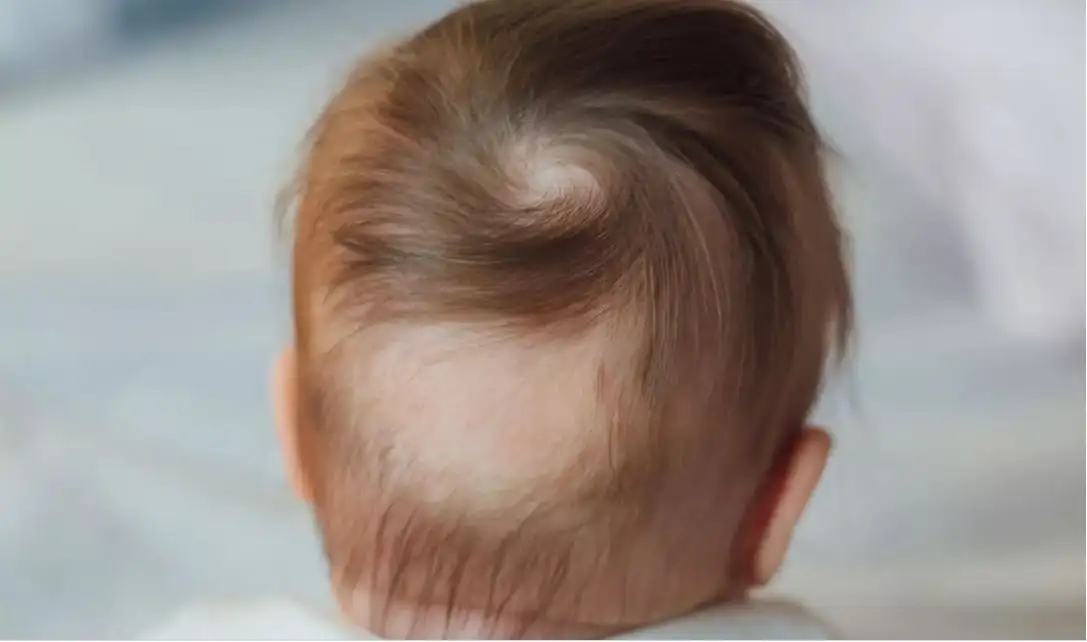 Alopecia Areata in Kids