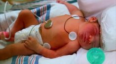 Baby Born Without Skull