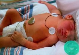 Baby Born Without Skull