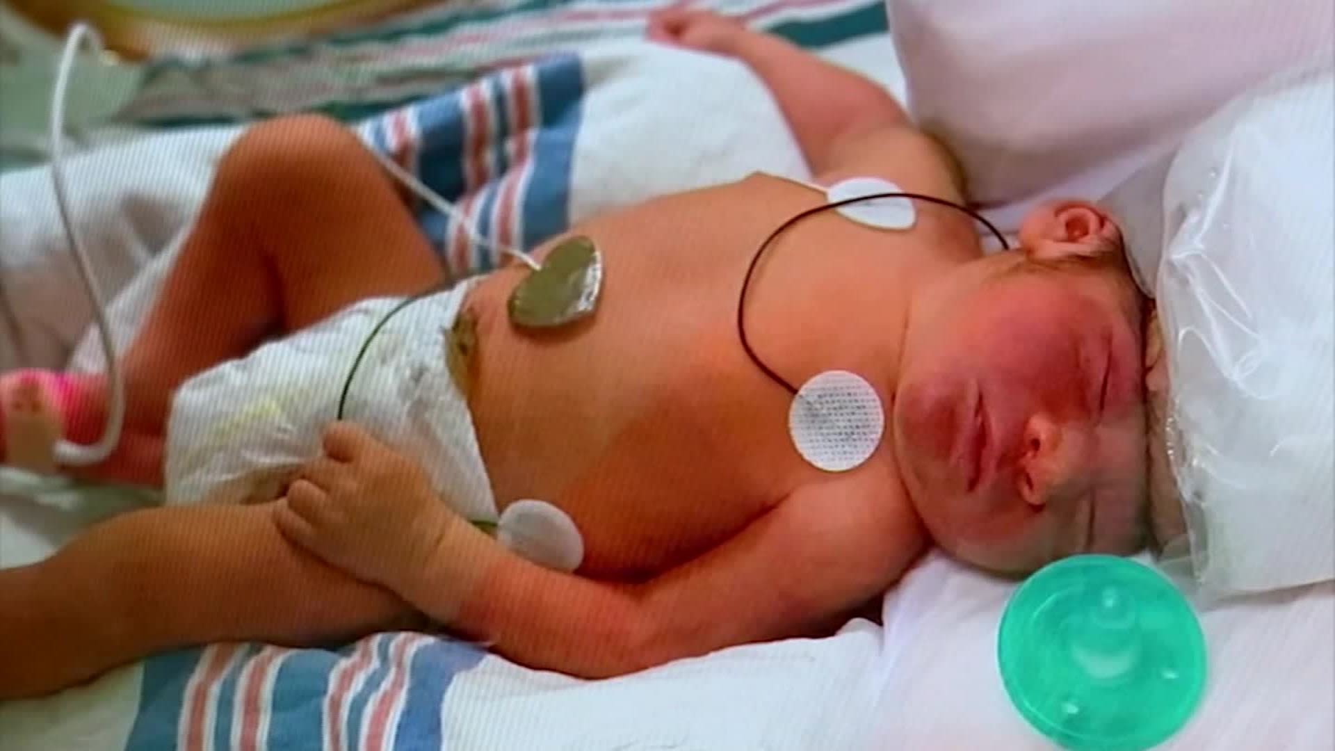 Baby Born Without Skull