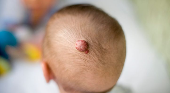 From Cute to Concerning How Hemangioma Transforms a Child’s Appearance