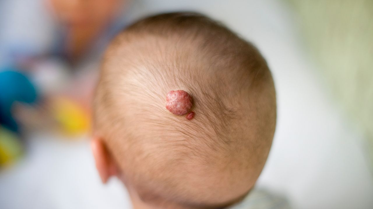 Hemangioma