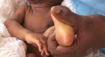 Is Your Baby Turning Yellow? What Every Parent Needs to Know About Jaundice!