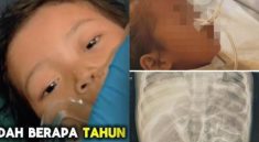 Toddler's Body Overrun by Worms