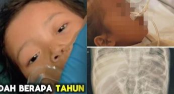 Shocking Tragedy! Toddler’s Body Overrun by Worms Leaves Doctors Horrified in Sukabumi