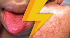 Kawasaki Disease