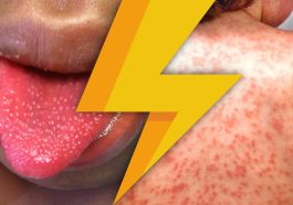 Kawasaki Disease