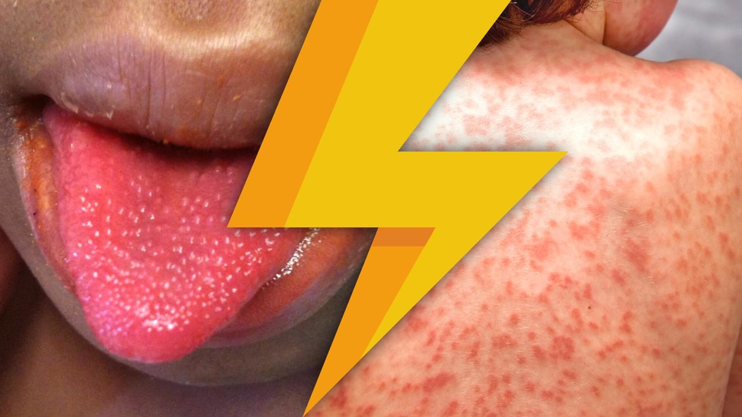 Kawasaki Disease