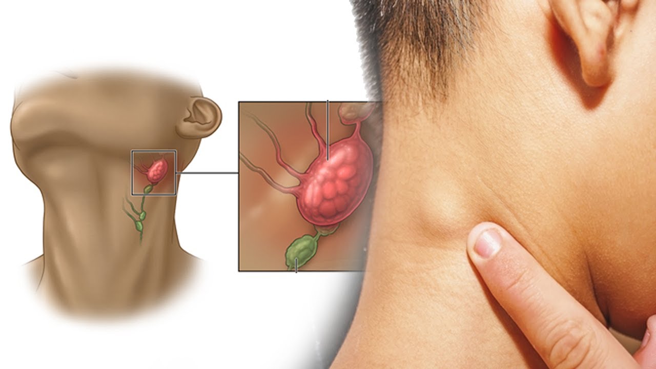 Lymph Node Disease