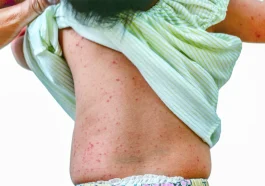Roseola