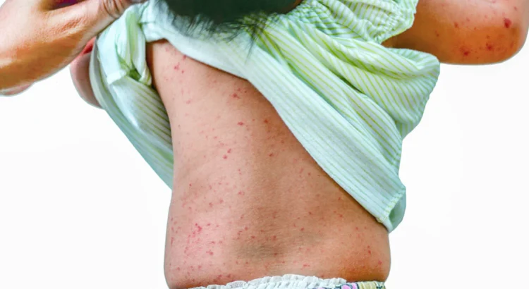 Roseola