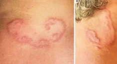 Severe Worm Infection