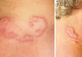 Severe Worm Infection