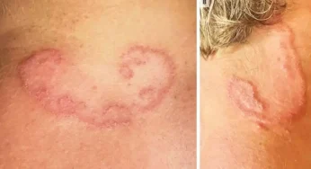 Shocking Symptoms of Severe Worm Infection in Kids, Are You Missing the Signs?