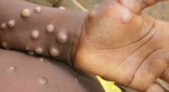 WHO Confirms Mpox Is Spreading Faster, 17 Dead in Africa, More Countries Affected